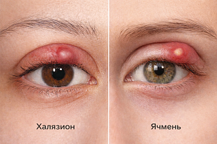 Отличия халязиона от ячменя