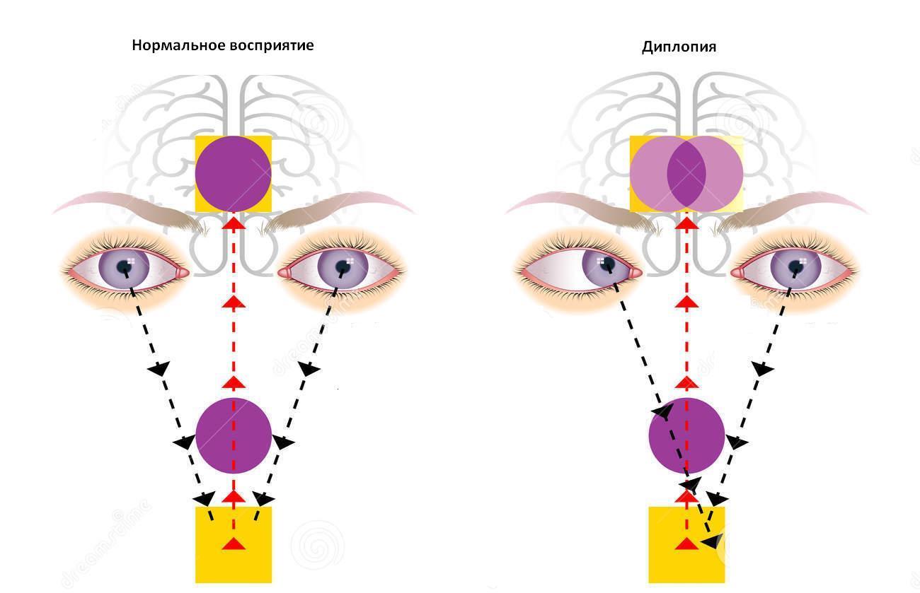 Совмещение зрительных осей от каждого глаза в одну точку в норме и при двоении (диплопии)