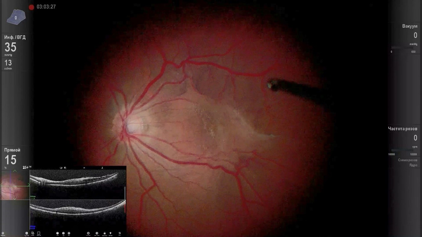 Картина глазного дна, которую хирург видит во время операции. В левом нижнем углу представлено интраоперационое ОКТ.
