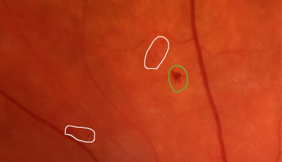 Микроаневримзмы (выделено белым) и микрогеморрагия (выделено зеленым) при диабетической ретинопатии