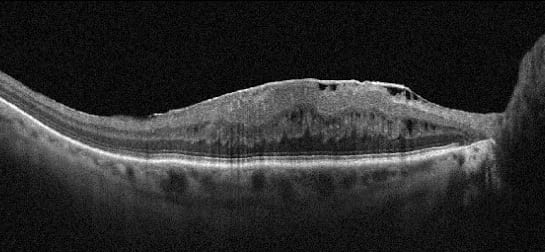 Оптическая когерентная томография макулярной области. Эпимакулярный фиброз. 