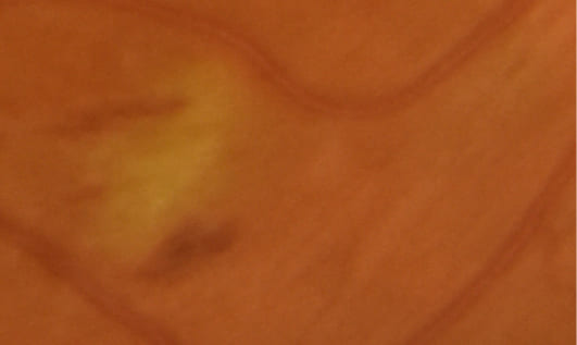 Зона микроинфаркта во внутернних слоях сетчатки, окруженная штриховыми микрогеморагиями – ватообразные очаги при диабетической ретинопатии. Материалы из архива ФГБНУ «НИИГБ» им. М.М. Краснова.