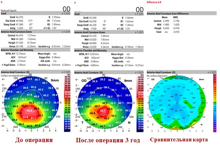 Сравнительные данные кератотопографии и пахиметрии до и псле проведения локального кросслинкинга роговицы
