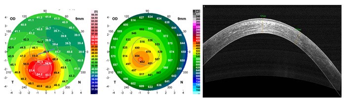 Данные кератотопографии, пахиметрии и ОКТ-роговицы до операции БЛОК