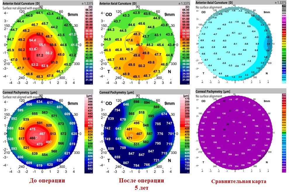 Данные кератотопографии и пахиметрии через 5 лет после операции БЛОК