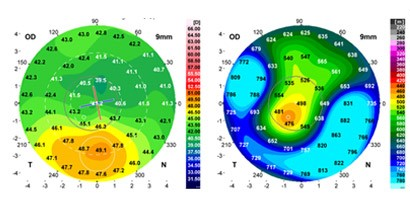 Данные кератотопографии, пахиметрии и ОКТ-роговицы до операции БЛОК